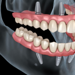 Getting dental implants in Tukwila: Check these FAQs