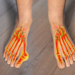 Bunions Be Gone! Treatments and Relief for Bunion Pain.