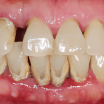 Dental Calculus: The Hidden Enemy of Oral Health