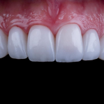 Advantages of Dental Veneers in Plymouth