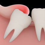 Operculum: Symptoms, Complications, and Treatment